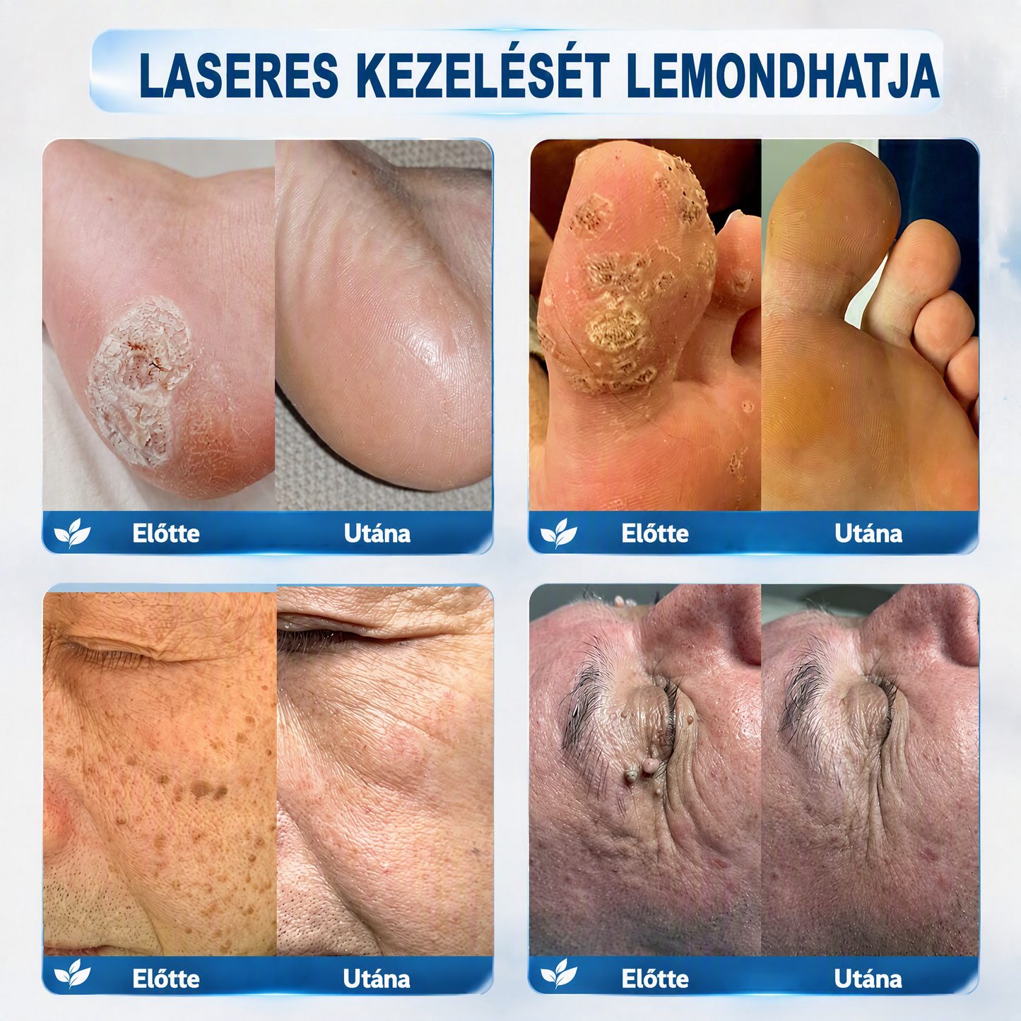 Autoryzowany sklep flagowy 🌿|🌥️ Vitalisys® 7-dniowy korektor do usuwania znamion i plam (rolka do usuwania bez bólu i bez blizn) 💟