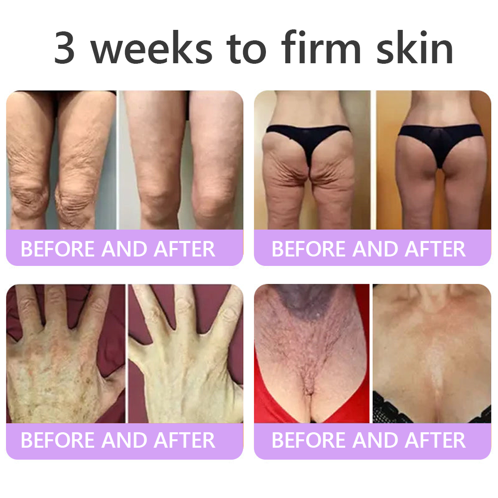 𝐃𝐞𝐫𝐦𝐚𝐭𝐨𝐥𝐨𝐠𝐢𝐬𝐭-𝐑𝐞𝐜𝐨𝐦𝐦𝐞𝐧𝐝𝐞𝐝 👩‍⚕️|💎 𝑽𝒊𝙩𝙖l𝗶𝘀𝐲𝐬® 𝙋𝘿𝙍𝙉 𝙈𝙪𝙡𝙩𝙞-𝙋𝙚𝙥𝙩𝙞𝙙𝙚 𝑴𝒂𝒔𝒔𝒂𝒈𝒊𝒏𝒈 𝑩𝒐𝒅𝒚 𝑹𝒐𝒍𝒍𝒆𝒓 𝑪𝒓𝒆𝒂𝒎- 𝑨𝒏𝒕𝒊-𝒂𝒈𝒊𝒏𝒈, 𝐇𝐲𝐝𝐫𝐚𝐭𝐢𝐧𝐠, 𝐒𝐤𝐢𝐧 𝐅𝐢𝐫𝐦𝐢𝐧𝐠 & 𝐋𝐢𝐟𝐭𝐢𝐧𝐠, 𝗦𝗸𝗶𝗻 𝗥𝗲𝗽𝗮𝗶𝗿, 𝗘𝘃𝗲𝗻 𝗧𝗼𝗻𝗲, 𝗔𝗰𝗻𝗲 𝗮𝗻𝗱 𝗗𝗮𝗿𝗸 𝗦𝗽𝗼𝘁 𝗧𝗿𝗲𝗮𝘁𝗺𝗲𝗻𝘁, 𝗪𝗮𝗿𝘁 𝗮𝗻𝗱 𝗠𝗼𝗹𝗲 𝗥𝗲𝗺𝗼𝘃𝗮𝗹, 𝗮𝗻𝗱 𝗣𝘀𝗼𝗿𝗶𝗮𝘀𝗶𝘀 𝗥𝗲𝗹𝗶𝗲𝗳.