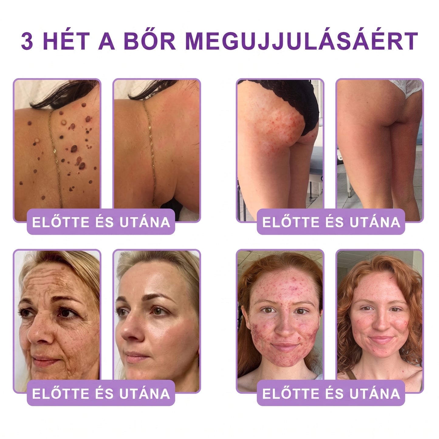 Bőrgyógyászok által ajánlott👩‍⚕️ |🥇 Vitalisys® PDRN Multi-Peptide Masszírozó Testápoló Krém – Öregedésgátló, hidratáló, feszesítő, bőrregeneráló, egységesítő, pattanás- és folteltávolító, szemölcs- és anyajegy-eltávolító, pikkelysömör enyhítő.🍇