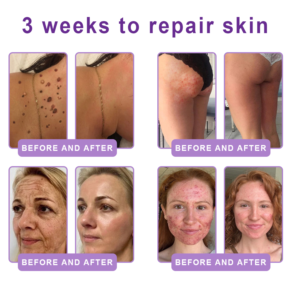 𝐃𝐞𝐫𝐦𝐚𝐭𝐨𝐥𝐨𝐠𝐢𝐬𝐭-𝐑𝐞𝐜𝐨𝐦𝐦𝐞𝐧𝐝𝐞𝐝 👩‍⚕️|💎 𝑽𝒊𝙩𝙖l𝗶𝘀𝐲𝐬® 𝙋𝘿𝙍𝙉 𝙈𝙪𝙡𝙩𝙞-𝙋𝙚𝙥𝙩𝙞𝙙𝙚 𝑴𝒂𝒔𝒔𝒂𝒈𝒊𝒏𝒈 𝑩𝒐𝒅𝒚 𝑹𝒐𝒍𝒍𝒆𝒓 𝑪𝒓𝒆𝒂𝒎- 𝑨𝒏𝒕𝒊-𝒂𝒈𝒊𝒏𝒈, 𝐇𝐲𝐝𝐫𝐚𝐭𝐢𝐧𝐠, 𝐒𝐤𝐢𝐧 𝐅𝐢𝐫𝐦𝐢𝐧𝐠 & 𝐋𝐢𝐟𝐭𝐢𝐧𝐠, 𝗦𝗸𝗶𝗻 𝗥𝗲𝗽𝗮𝗶𝗿, 𝗘𝘃𝗲𝗻 𝗧𝗼𝗻𝗲, 𝗔𝗰𝗻𝗲 𝗮𝗻𝗱 𝗗𝗮𝗿𝗸 𝗦𝗽𝗼𝘁 𝗧𝗿𝗲𝗮𝘁𝗺𝗲𝗻𝘁, 𝗪𝗮𝗿𝘁 𝗮𝗻𝗱 𝗠𝗼𝗹𝗲 𝗥𝗲𝗺𝗼𝘃𝗮𝗹, 𝗮𝗻𝗱 𝗣𝘀𝗼𝗿𝗶𝗮𝘀𝗶𝘀 𝗥𝗲𝗹𝗶𝗲𝗳.
