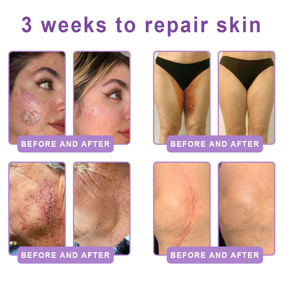 𝐃𝐞𝐫𝐦𝐚𝐭𝐨𝐥𝐨𝐠𝐢𝐬𝐭-𝐑𝐞𝐜𝐨𝐦𝐦𝐞𝐧𝐝𝐞𝐝 👩‍⚕️|💎 𝑽𝒊𝙩𝙖l𝗶𝘀𝐲𝐬® 𝙋𝘿𝙍𝙉 𝙈𝙪𝙡𝙩𝙞-𝙋𝙚𝙥𝙩𝙞𝙙𝙚 𝑴𝒂𝒔𝒔𝒂𝒈𝒊𝒏𝒈 𝑩𝒐𝒅𝒚 𝑹𝒐𝒍𝒍𝒆𝒓 𝑪𝒓𝒆𝒂𝒎- 𝑨𝒏𝒕𝒊-𝒂𝒈𝒊𝒏𝒈, 𝐇𝐲𝐝𝐫𝐚𝐭𝐢𝐧𝐠, 𝐒𝐤𝐢𝐧 𝐅𝐢𝐫𝐦𝐢𝐧𝐠 & 𝐋𝐢𝐟𝐭𝐢𝐧𝐠, 𝗦𝗸𝗶𝗻 𝗥𝗲𝗽𝗮𝗶𝗿, 𝗘𝘃𝗲𝗻 𝗧𝗼𝗻𝗲, 𝗔𝗰𝗻𝗲 𝗮𝗻𝗱 𝗗𝗮𝗿𝗸 𝗦𝗽𝗼𝘁 𝗧𝗿𝗲𝗮𝘁𝗺𝗲𝗻𝘁, 𝗪𝗮𝗿𝘁 𝗮𝗻𝗱 𝗠𝗼𝗹𝗲 𝗥𝗲𝗺𝗼𝘃𝗮𝗹, 𝗮𝗻𝗱 𝗣𝘀𝗼𝗿𝗶𝗮𝘀𝗶𝘀 𝗥𝗲𝗹𝗶𝗲𝗳.