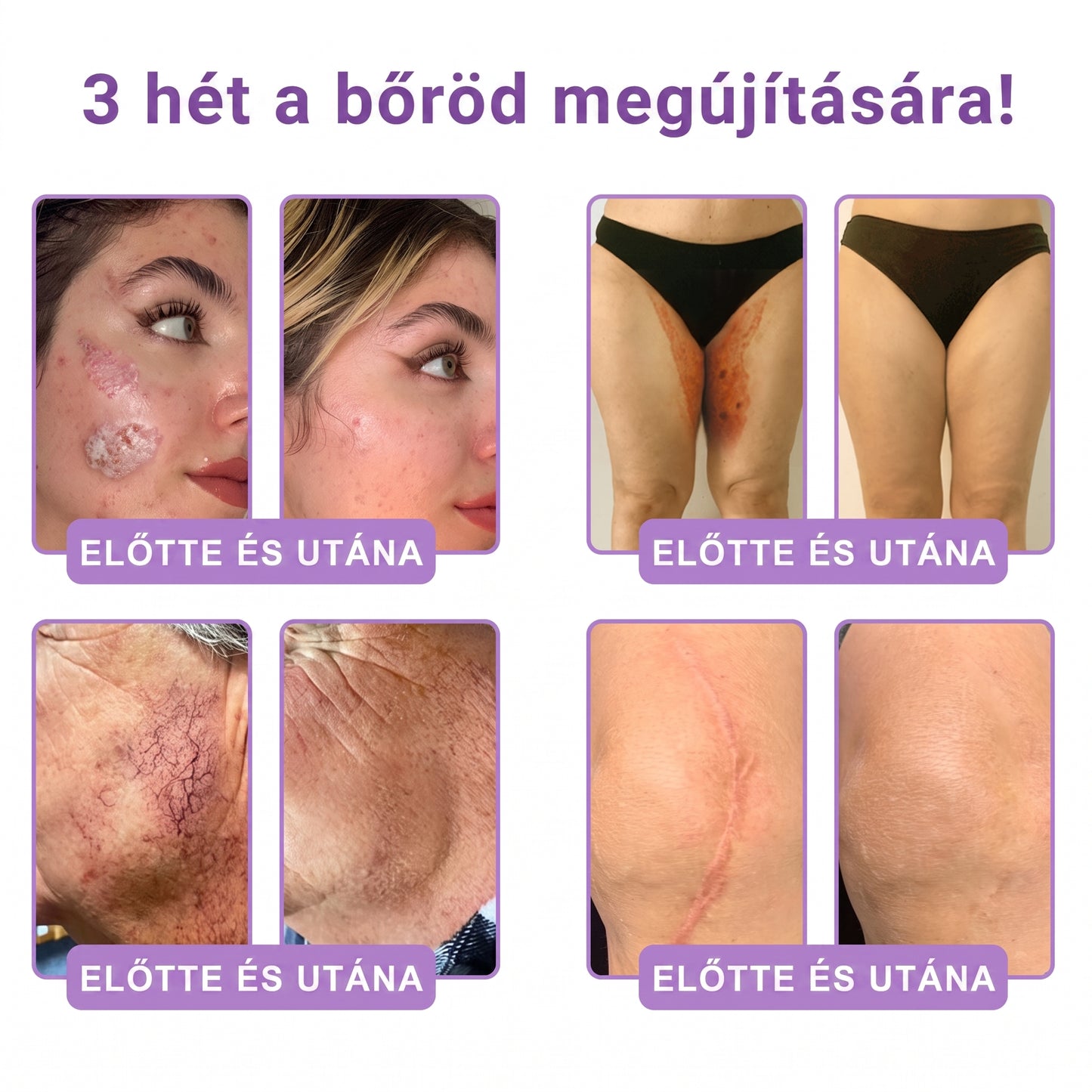 Bőrgyógyászok által ajánlott👩‍⚕️ |🥇 Vitalisys® PDRN Multi-Peptide Masszírozó Testápoló Krém – Öregedésgátló, hidratáló, feszesítő, bőrregeneráló, egységesítő, pattanás- és folteltávolító, szemölcs- és anyajegy-eltávolító, pikkelysömör enyhítő.🍇